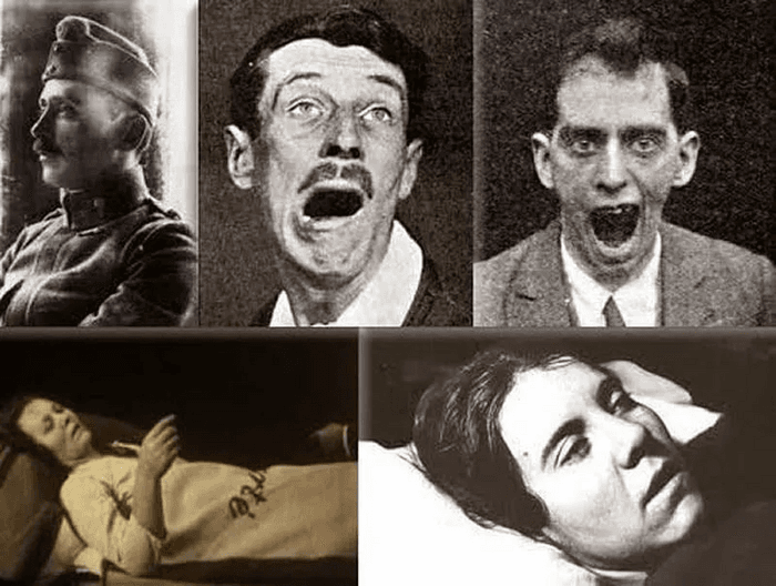 Constantin von Economo with patients affected by encephalitis lethargica, displaying the characteristic frozen postures of the disease