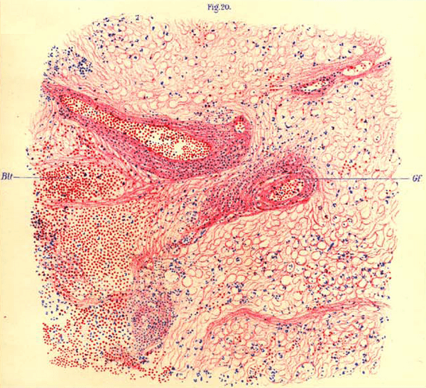 Microscopic view of brain tissue affected by encephalitis lethargica, from von Economo's original 1918 publication